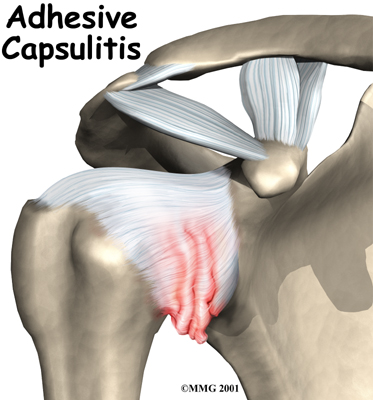 shoulder_adhesive_capsulitis_intro01