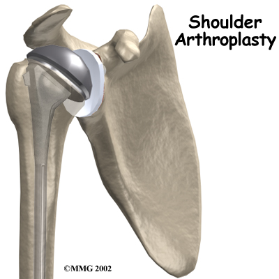 shoulder_arthroplasty_intro01