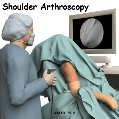shoulder_arthroscopy_intro01
