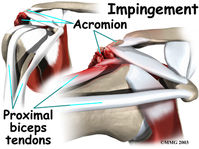 shoulder_biceps_tendonitis_causes02