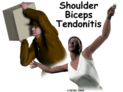 shoulder_biceps_tendonitis_intro01