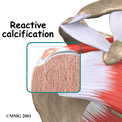shoulder_calcific_anatomy02