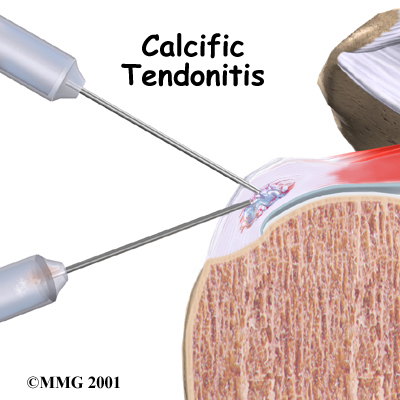 shoulder_calcific_intro01