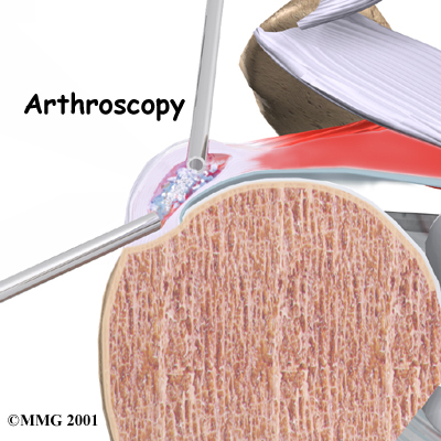 shoulder_calcific_surgery01