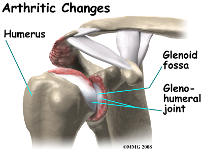 shoulder_cuff_tear_arthropathy_causes02