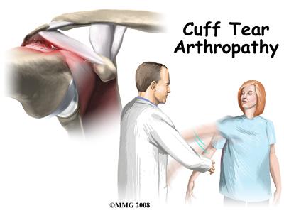 shoulder_cuff_tear_arthropathy_intro01