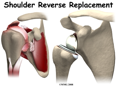 shoulder_cuff_tear_arthropathy_reverse_surgery03