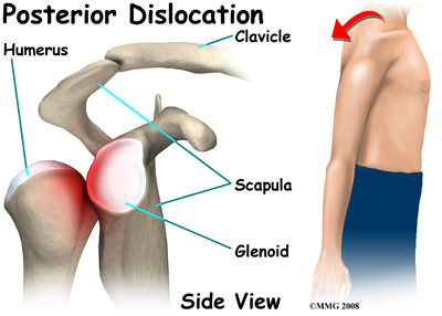 shoulder_dislocation_anatomy12
