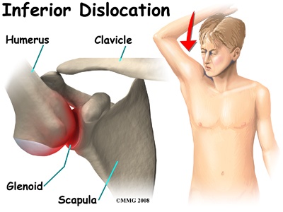 shoulder_dislocation_anatomy13