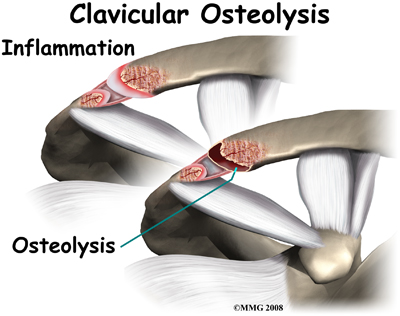 shoulder_distal_clav_osteolysis_causes02