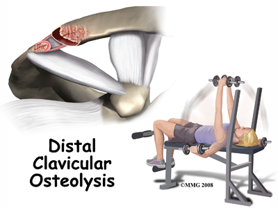 shoulder_distal_clav_osteolysis_intro01