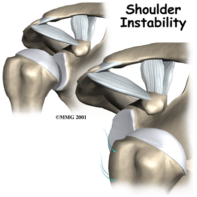 shoulder_instability_intro01