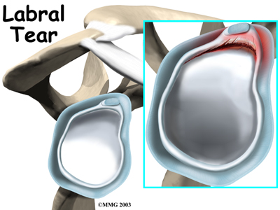 shoulder_labral_tear_intro01