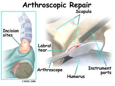 shoulder_labral_tear_treatment01