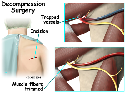 shoulder_quad_space_treatment01
