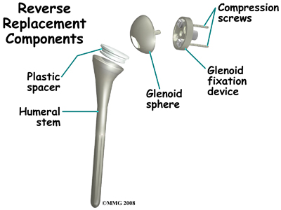 shoulder_reverse_components_surgery01
