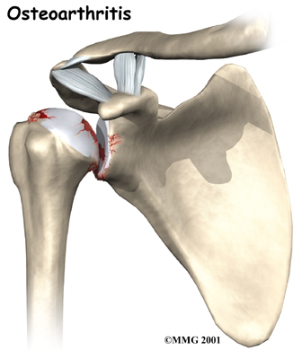 shoulder_reverse_oa_rationale01