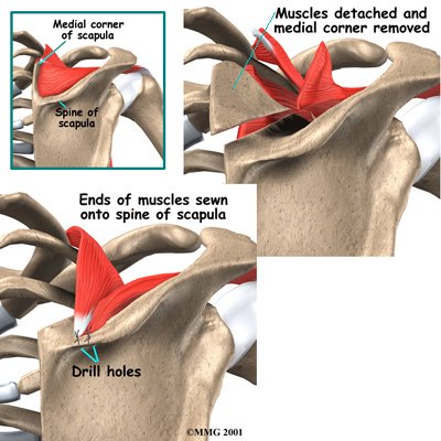 shoulder_snap_surgery01