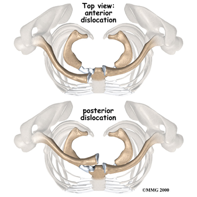 shoulder_stclav_cause01