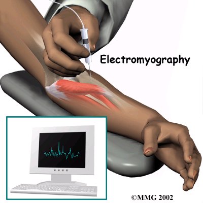 shoulder_thoracic_outlet_syndrome_diagnosis01