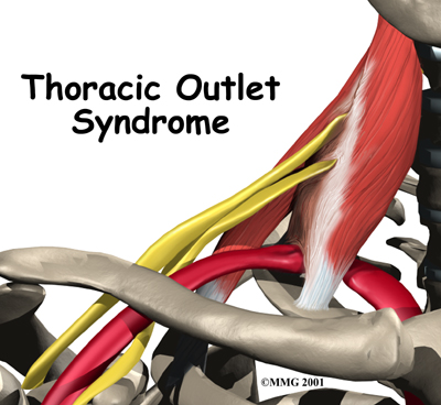 shoulder_thoracic_outlet_syndrome_intro01