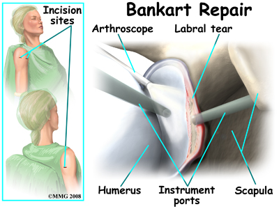 shoulder_unstable_treatment03