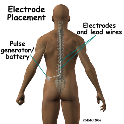 spinal_stim_devices04