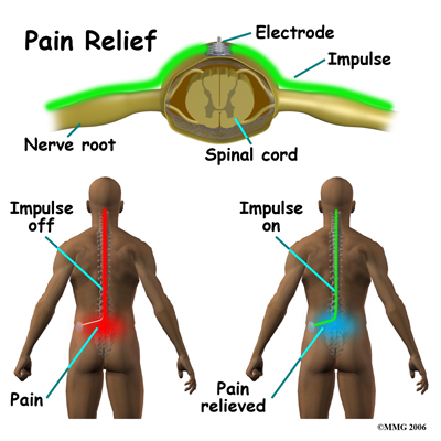 spinal_stim_rationale01