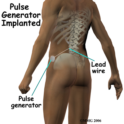 spinal_stim_surgery04