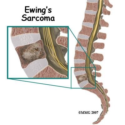 spinal_tumor_ewings01