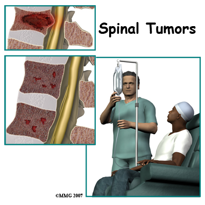 spinal_tumor_intro01