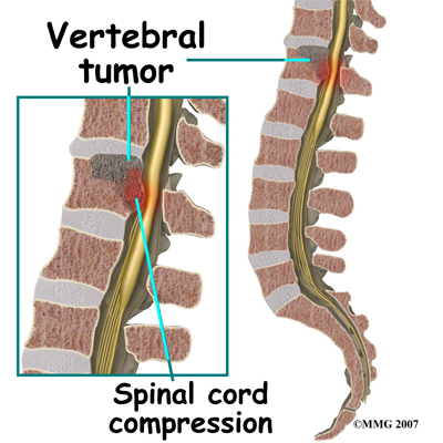spinal_tumor_invasion01