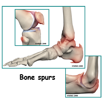 spine_general_DISH_causes02
