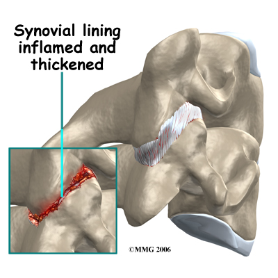 spondylo_anatomy02