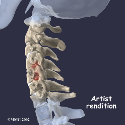 spondylo_diagnosis01