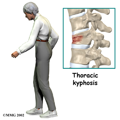 thoracic_compression_fx_cause02