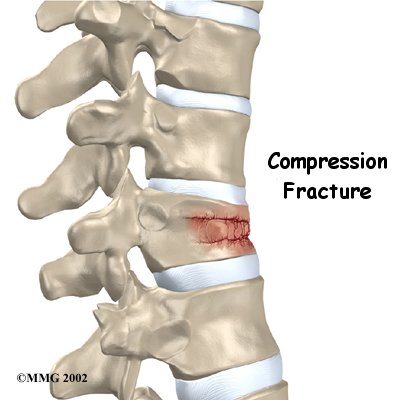thoracic_compression_fx_intro01