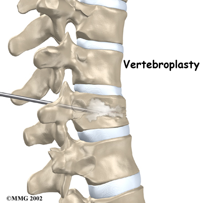 thoracic_compression_fx_treatment02