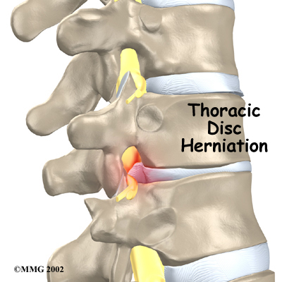thoracic_herniation_intro01