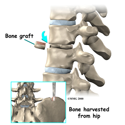thoracic_herniation_surgery04