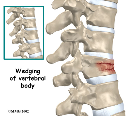 thoracic_kyphoplasty_anatomy01
