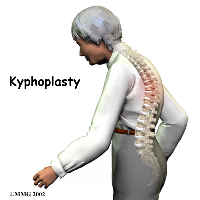 thoracic_kyphoplasty_intro01