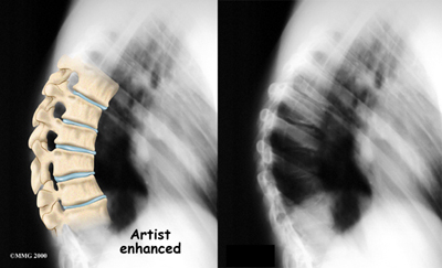 thoracic_scheuermanns_diagnosis01