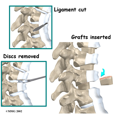 thoracic_scheuermanns_surgery02