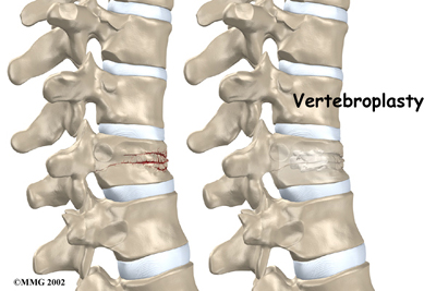 thoracic_vertebroplasty_intro01