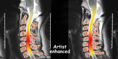 whiplash_mri
