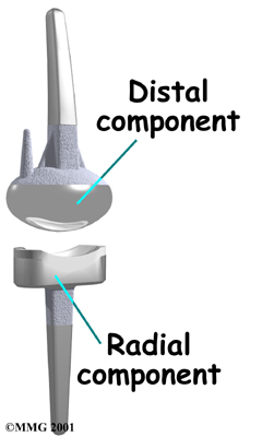 wrist_arthroplasty_component03