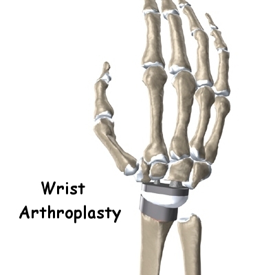 wrist_arthroplasty_intro01
