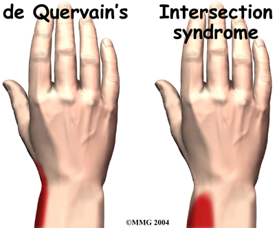 wrist_dequervains_diagnosis01