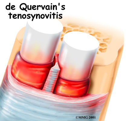 wrist_dequervains_intro01